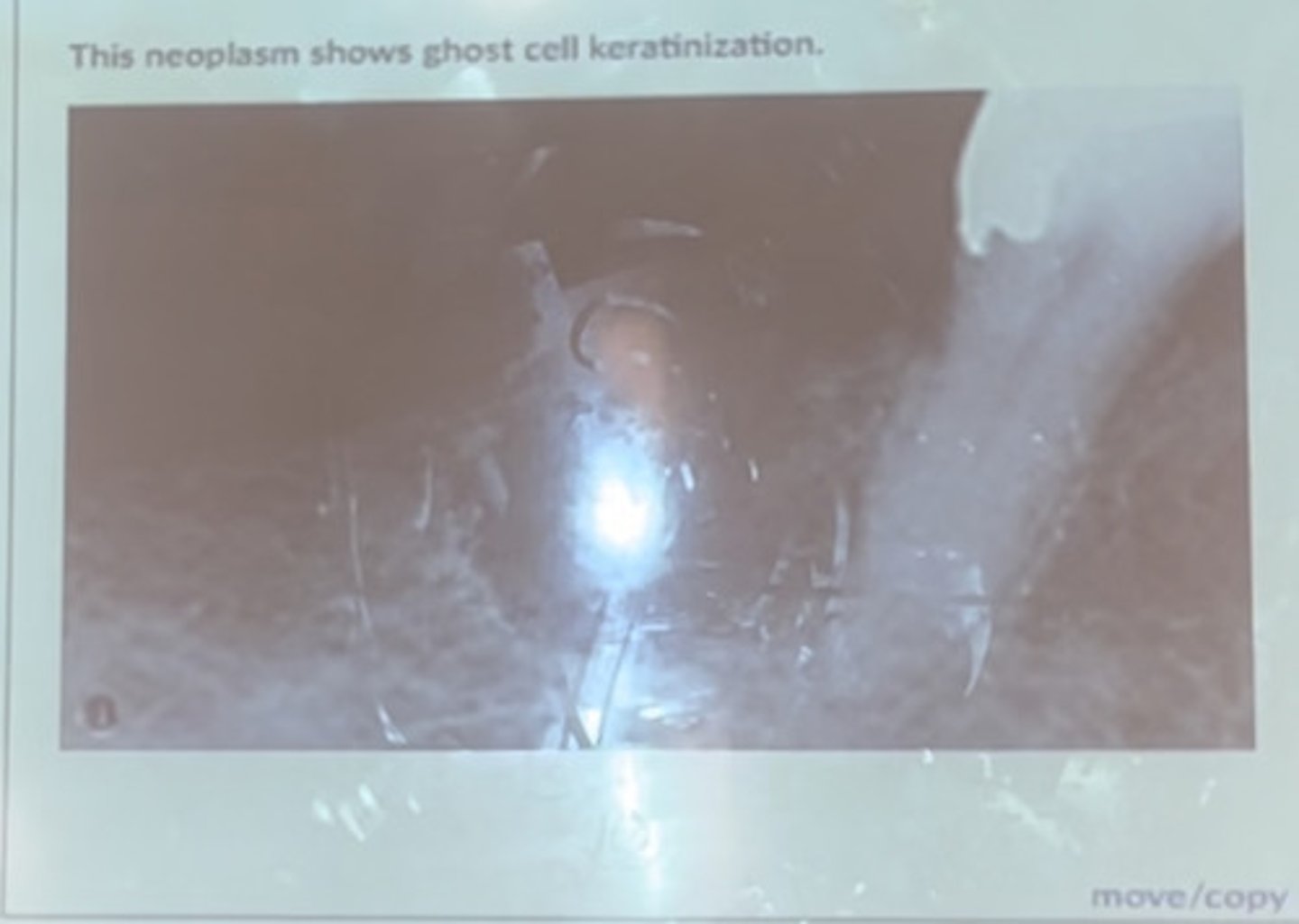<p>This neoplasm shows ghost cell keratinization</p>