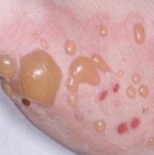 <p>A circumscribed, elevated lesion that is more than 5mm in diameter, usually contains serous fluid and looks like a blister</p>