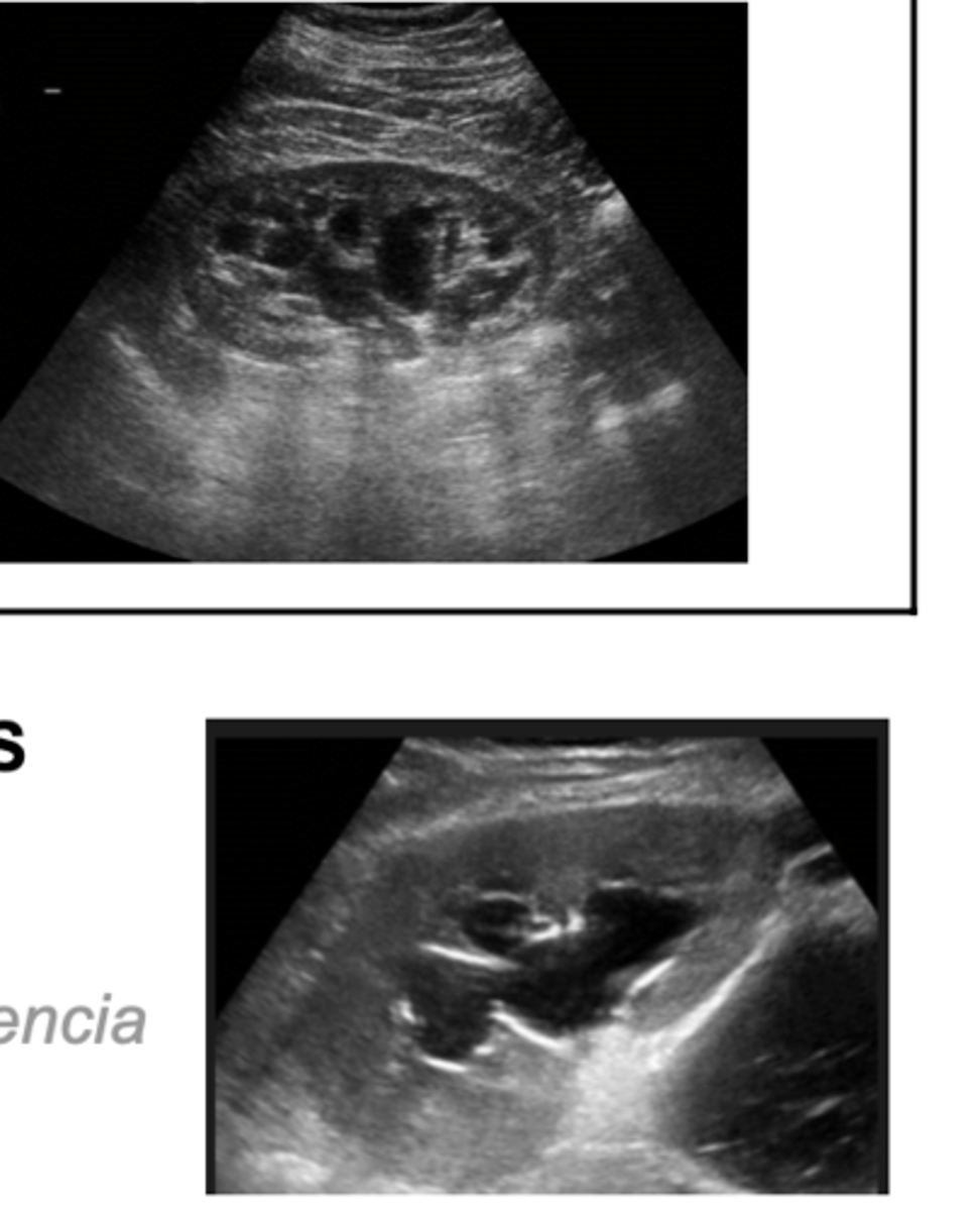 <p>- Quistes → Bien definidos, redondos.</p><p>- Hidronefrosis → Dilatación más difusa del sistema colector renal.</p><p>SUPERIOR :QUISTES</p><p>INFERIOR : HIDRONEFROSIS</p>