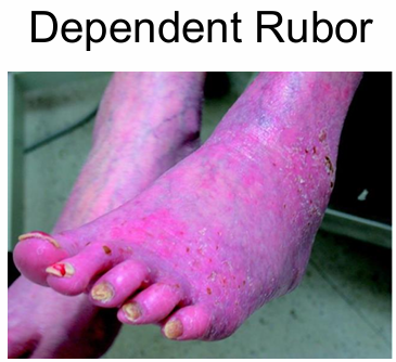 <ul><li><p><span>Thin, Shiny, dry skin</span></p></li><li><p><span>Hair loss on ankle and foot</span></p></li><li><p><span>Dystrophic (thick) or yellow toenails</span></p></li><li><p><span>Elevation pallor</span></p></li><li><p><span>Dependent rubor</span></p></li><li><p><span>Decreased temperature</span></p></li><li><p><span>Absent or diminished pulses</span></p></li><li><p><span>Cyanosis</span></p></li><li><p><span>Ischemic pain</span></p></li></ul><p></p>