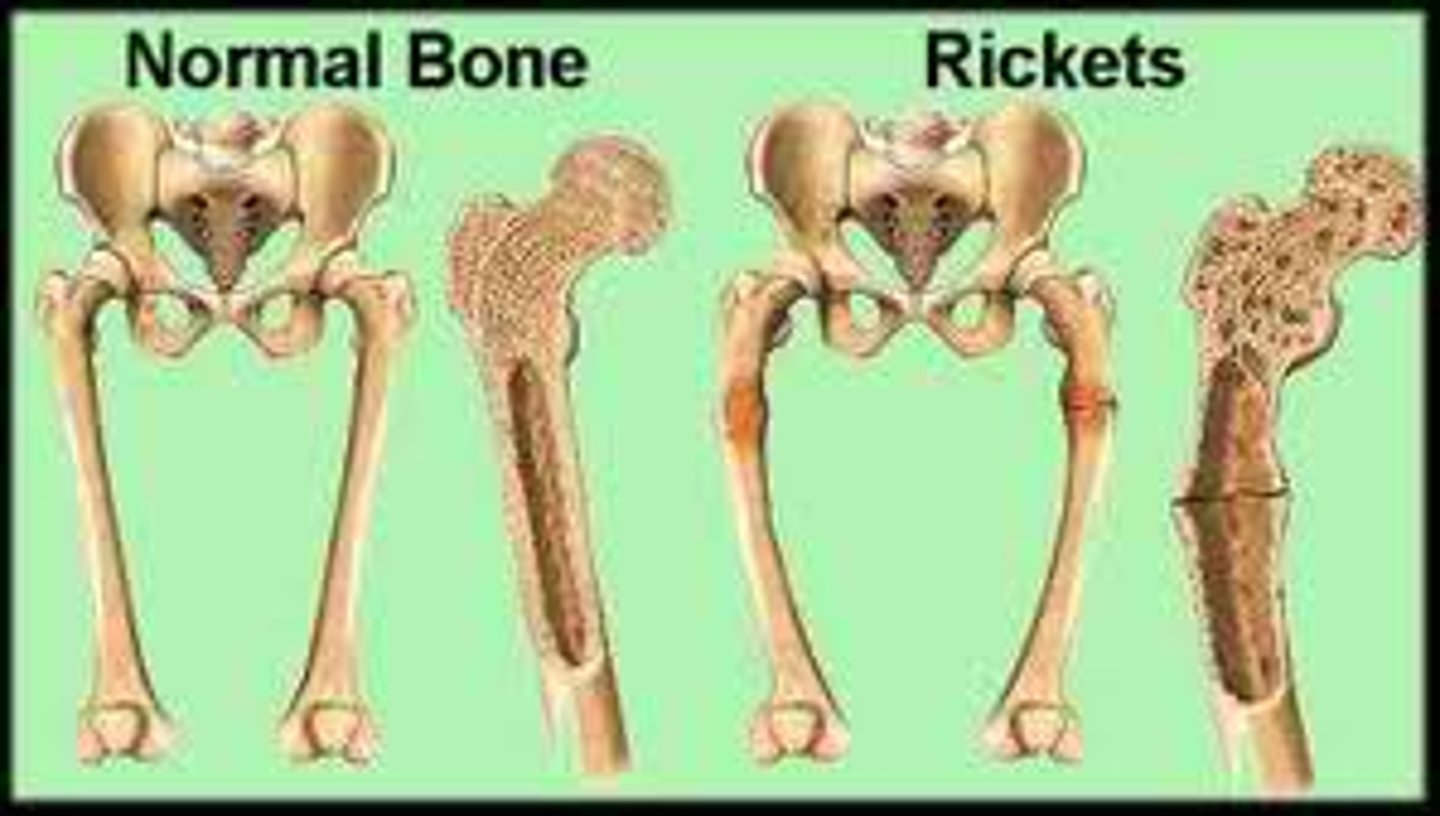 <p>disease marked by softening of the bone caused by calcium and vitamin D deficiency</p>