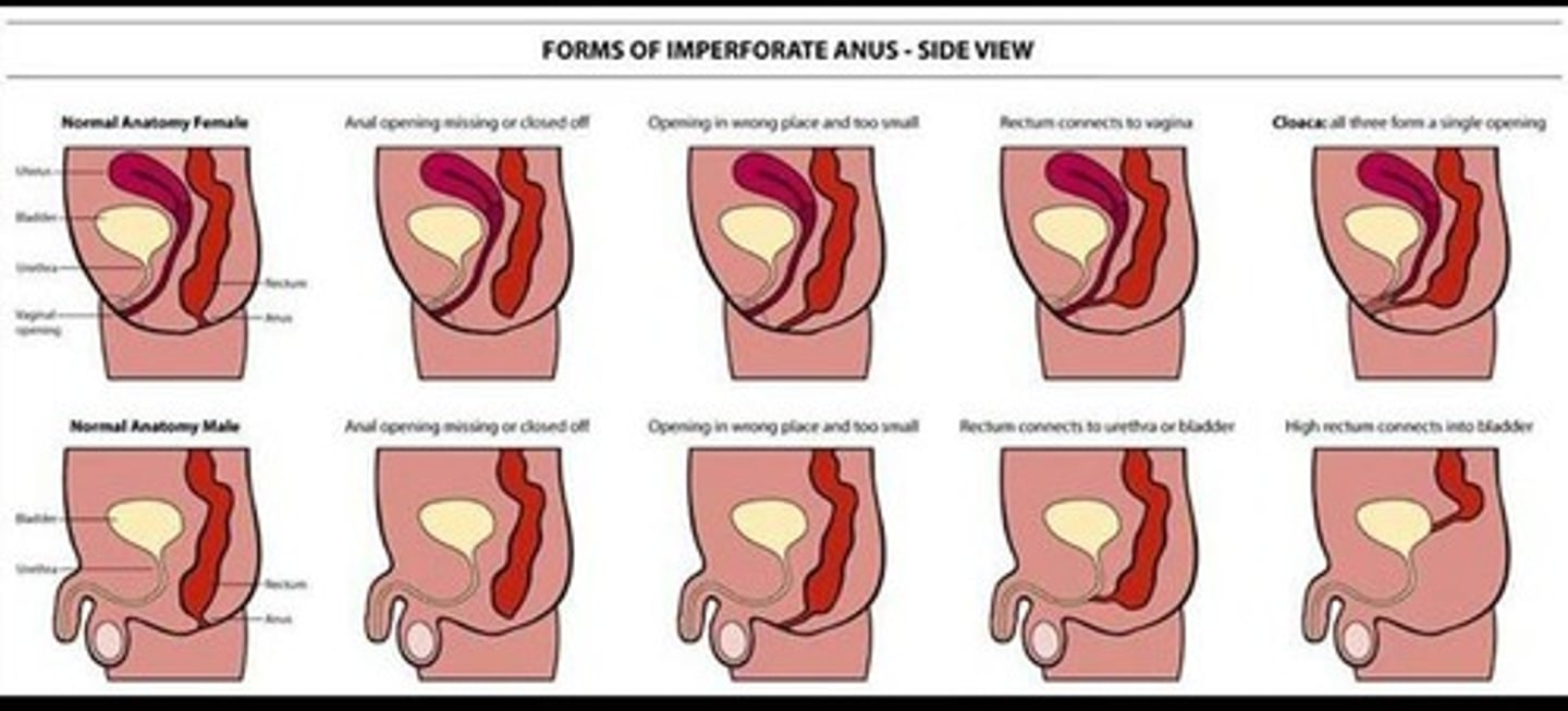 <p>failure of the anus to connect to the rectum</p><p>- tx: colonstomy</p>