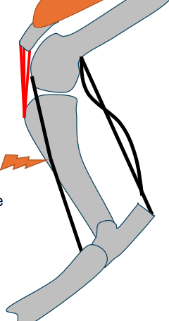 <p>What happens when the fibularis (peroneus) tertius ruptures?</p>