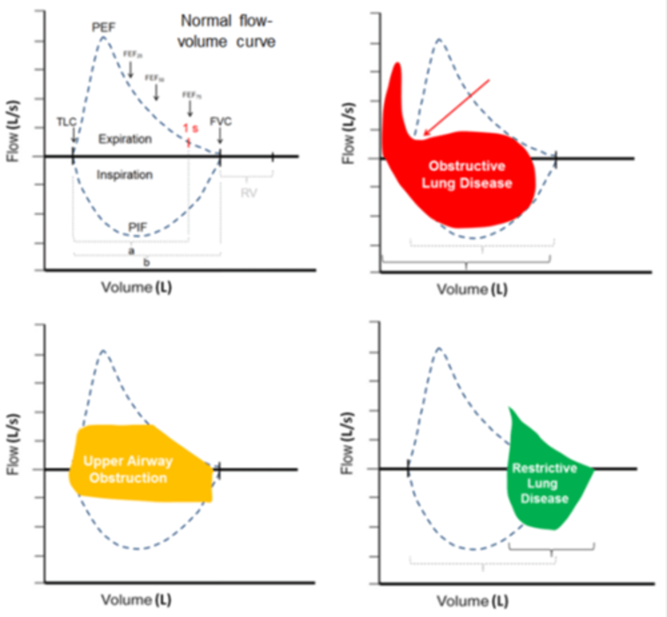 <p>yaxis - flow (L/s)</p><p>x-axis - volume (L) **start at 6L --> 2L</p><p>above 0 flow value = exiration</p><p>below 0 flow value = inspiration</p><p>Little circle : resting eupnaic breathing</p><p>Large loop: vital capacity</p><p>Dashed loop: durign exercis</p><p>Peak expiratory flow/PEF (at top)</p><p>Fev1 (somwhere around 3L)</p><p>FVC (width of the loop)</p><p>RV (whats passed the right of the loop)</p><p>IC (from left of loop to right of little loop)</p>