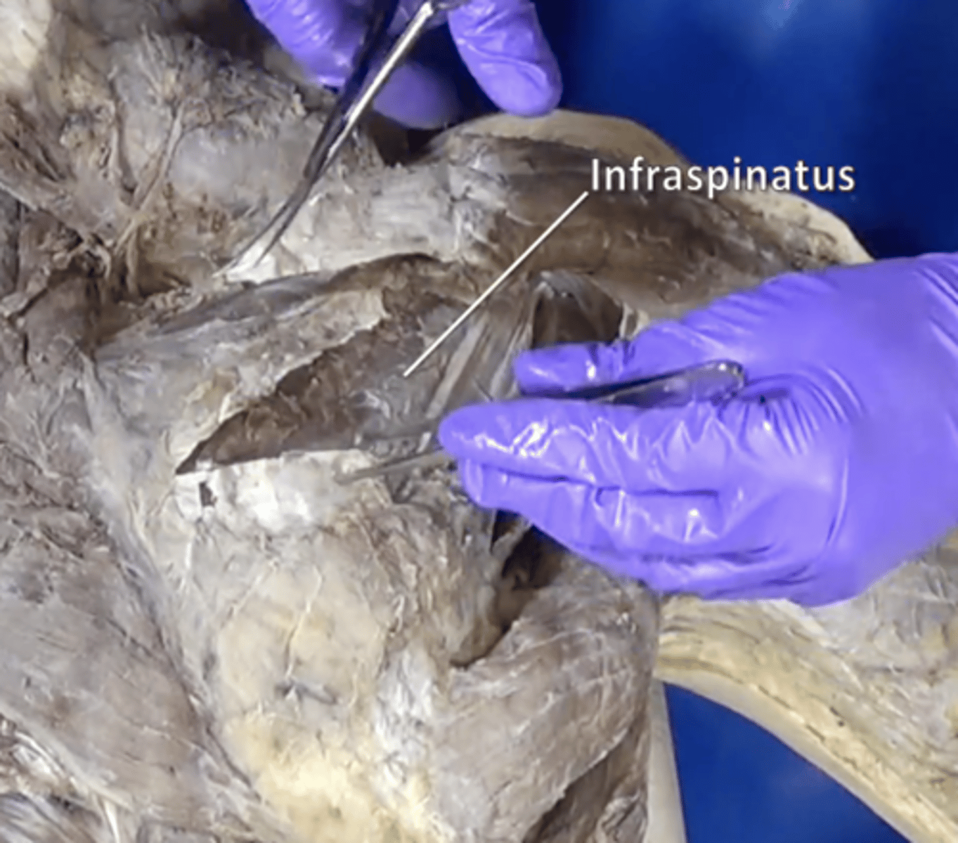 <p>adduction and lateral rotation of arm</p>