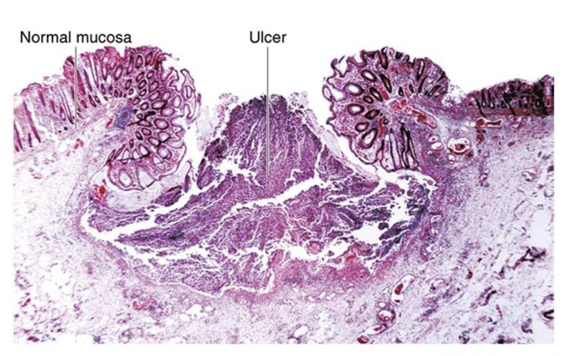 <ul><li><p>digestive protozoal disease</p></li><li><p>cause: <em>Entamoeba histolytica</em></p><ul><li><p>virulence: mature into trophozoites to invade intestinal mucosa; chlorination resistance</p></li></ul></li><li><p>transmission: ingestion of cysts from contaminated food or water</p></li><li><p>symptoms: dysentery and abdominal pain; peritonitis (severe)</p></li></ul><p></p>