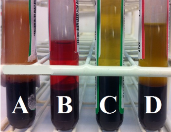 <p>Each day, laboratorians must evaluate the quality of samples submitted to the laboratory for analysis, specifically to help prevent pre- analytical errors. Based on the photograph to the right, match the tubes with letters to their correct corresponding descriptions below.</p><p></p><p>A-hemolyzed B-lipemic C-icteric D-normal</p><p>A-normal B-hemolyzed C-icteric D-hemolyzed</p><p>A-lipemic B-icteric C-normal D-hemolyzed</p><p>A-lipemic B-hemolyzed C-normal D-icteric</p>