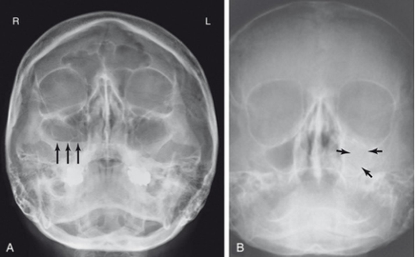 <p>- air-fluid level in the sinus</p><p>- complete opacification is found</p>