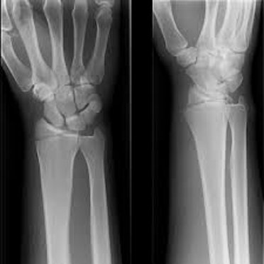 <p>What is an <strong>intra-articular fracture </strong>involving radial styloid?</p>