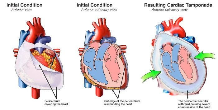 <p>Fluid buildup around the sac of the heart</p><ul><li><p>Associated with <u>chest trauma</u></p></li><li><p>Muffled heart tones, jugular venous distension and hypotension</p><ul><li><p>Can’t pump as well → Can’t hear it pumping, Veins cannot drain blood into the heart, so it backs up, and lack of blood in arteries leads to less pressure.</p></li></ul></li></ul><p></p>