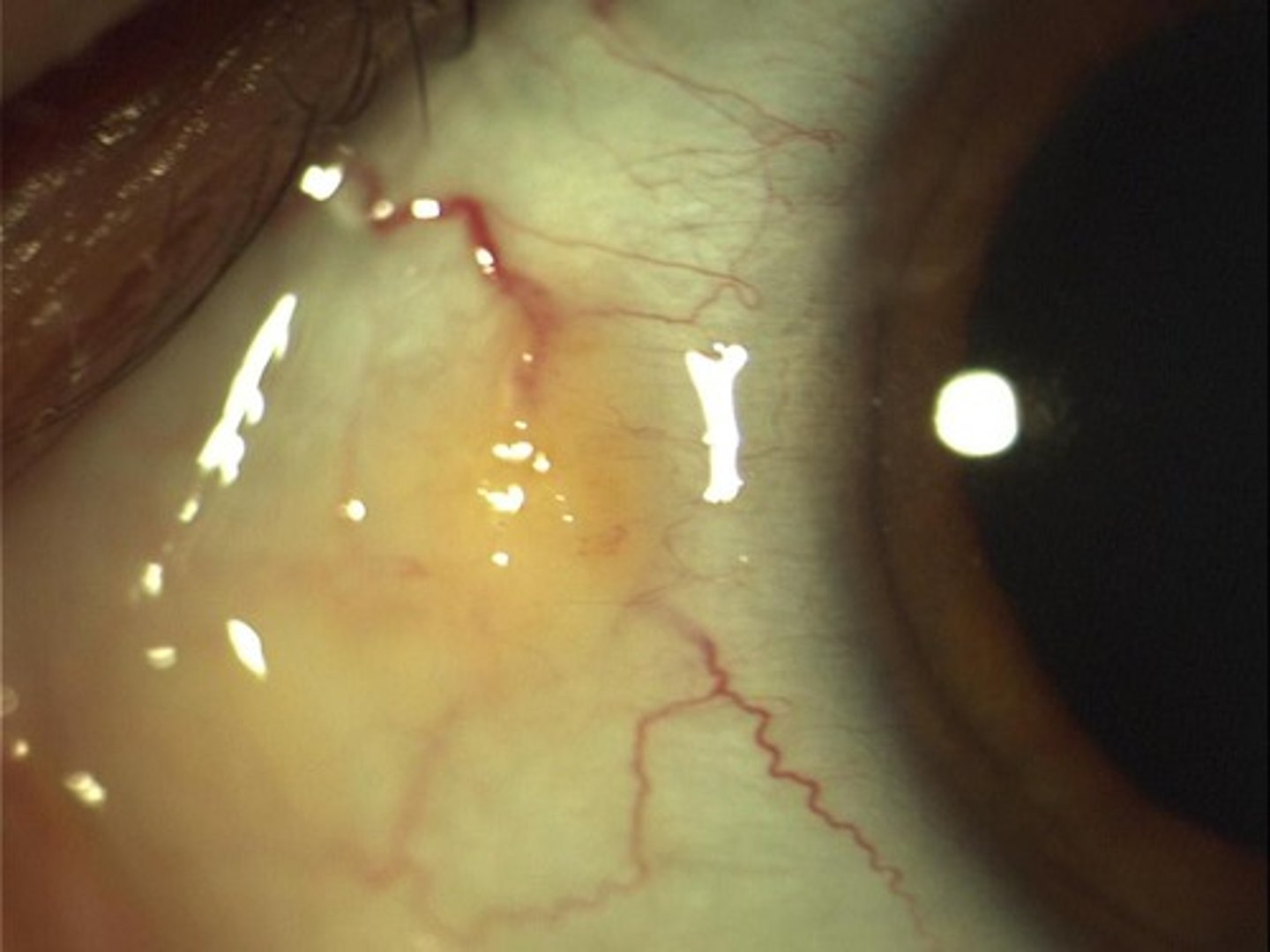 <p>A pinguecula is a yellowish nodule, particularly on the nasal aspect of the eye, but it may be lateral. It is often caused by wind and dust.</p>