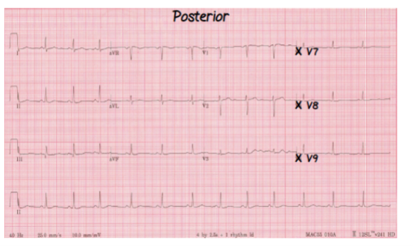 <p>Remember these points about posterior EKGs:</p>