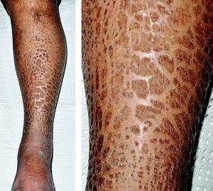 <p><span>Ichthyosis vulgaris</span></p>