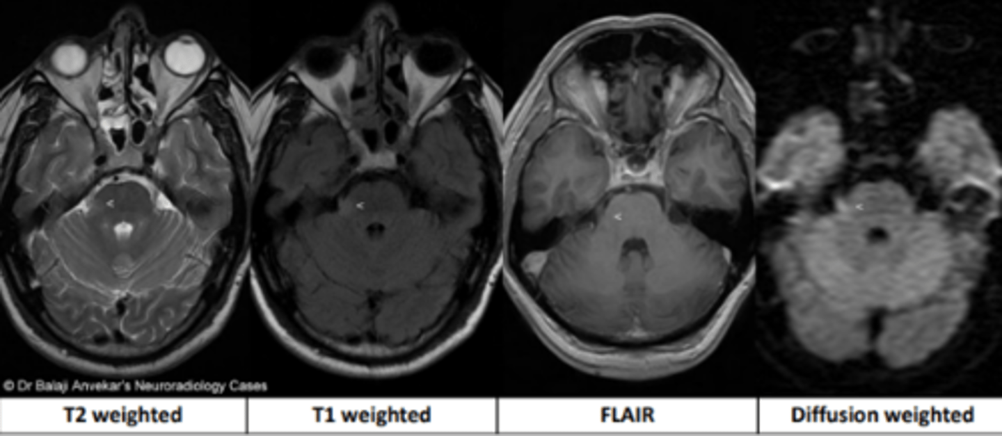 <p>a scan which uses magnetic and radio waves for detailed 3D imaging of the body. Has the ability to image a wide variety of structures including bone, soft tissues, organs, etc. Avoid in cases of metallic foreign bodies.</p>