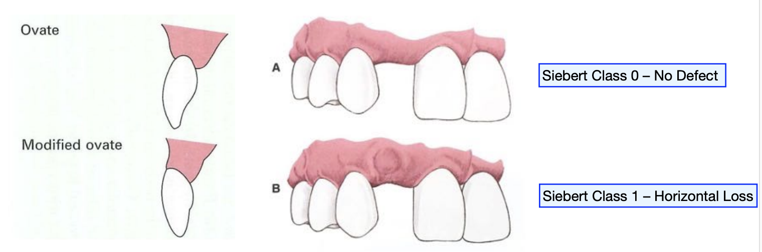 <p>horizontal ridge width is not sufficient for a conventional ovate pontic</p>