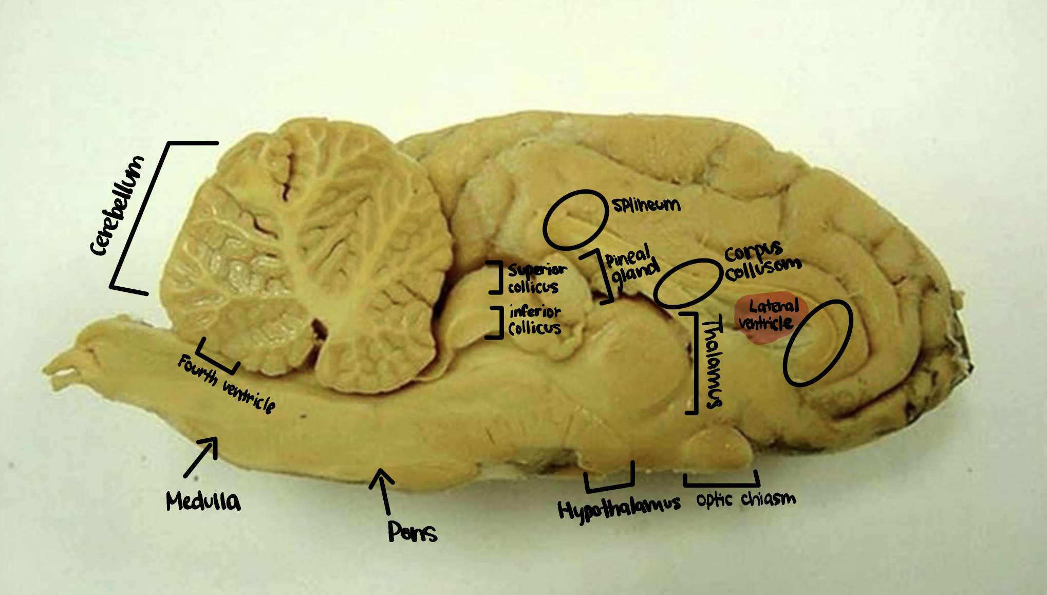 <p>Lateral Ventricle</p>