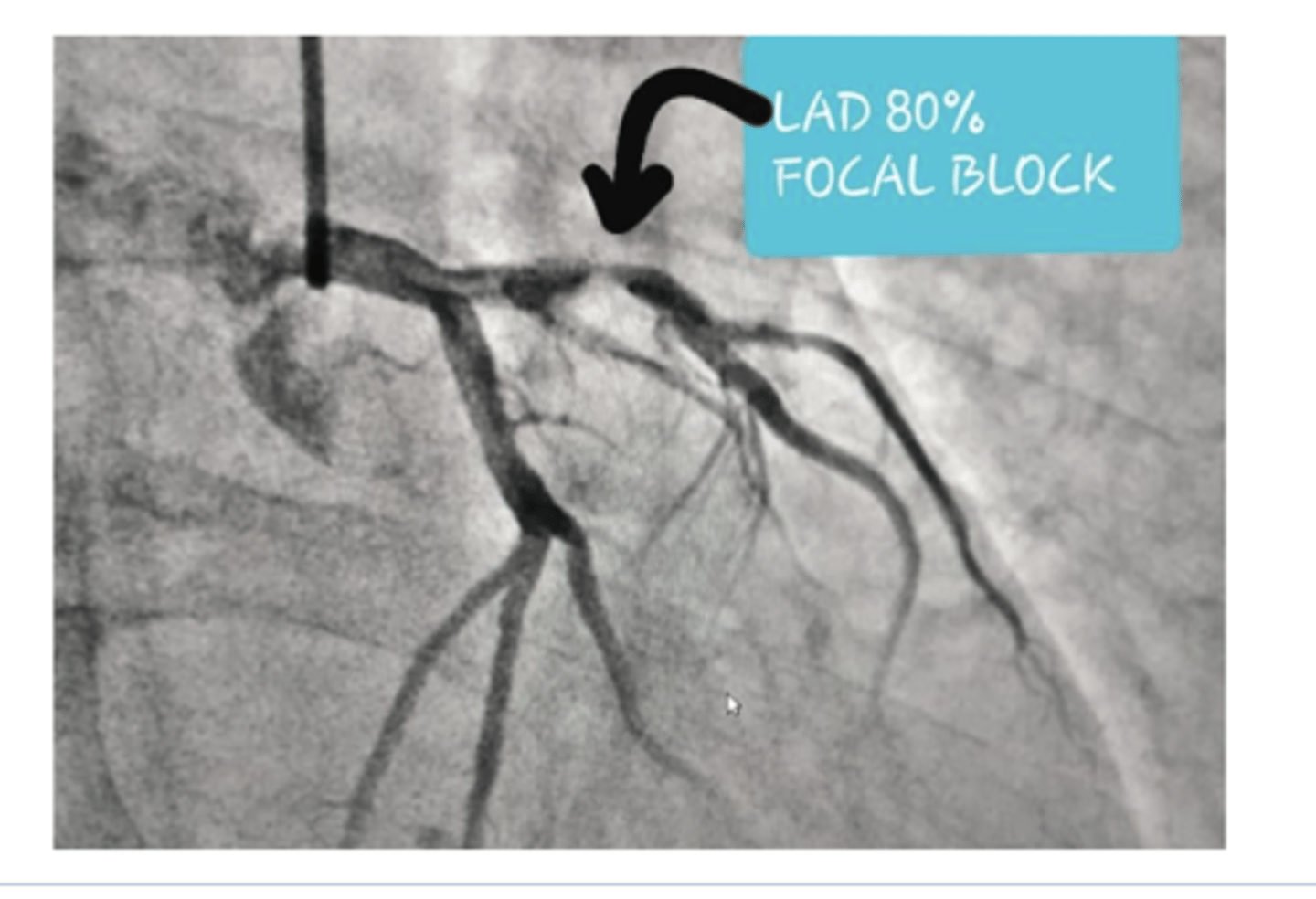 <p>◼ A thallium stress test evaluates the musculature of the</p><p>left ventricle during rest and under stress.</p><p>◼ The echocardiogram looks for regional wall motion abnormalities – can also be done with stress</p><p>◼ Coronary angiography (cardiac cath) is the best study to visualize the coronary arteries but is expensive, invasive and involves a high dose of radiation.</p>