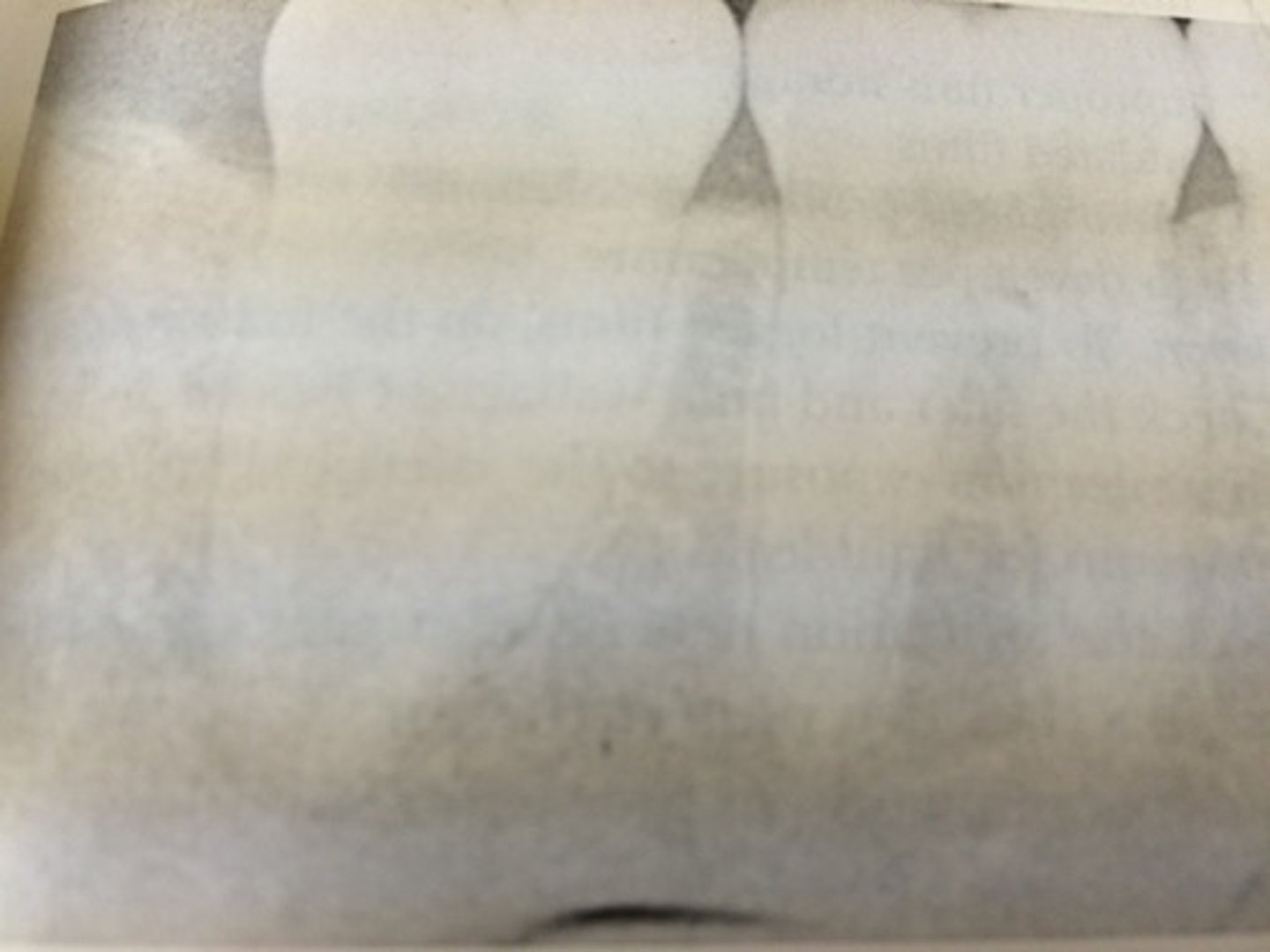 <p>when film emulsion is damaged by the operators fingernail</p><p>appears as a black crescent shape mark</p>