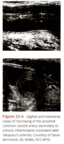 <p>Inflammatory disease that affects larger vessels such as Aorta, Subclavian, maybe CCA. Affects usually younger women. AKA “Pulseless disease”. Sono appear like “Donut” vessel. Vessel wall diffusely inflamed.</p>