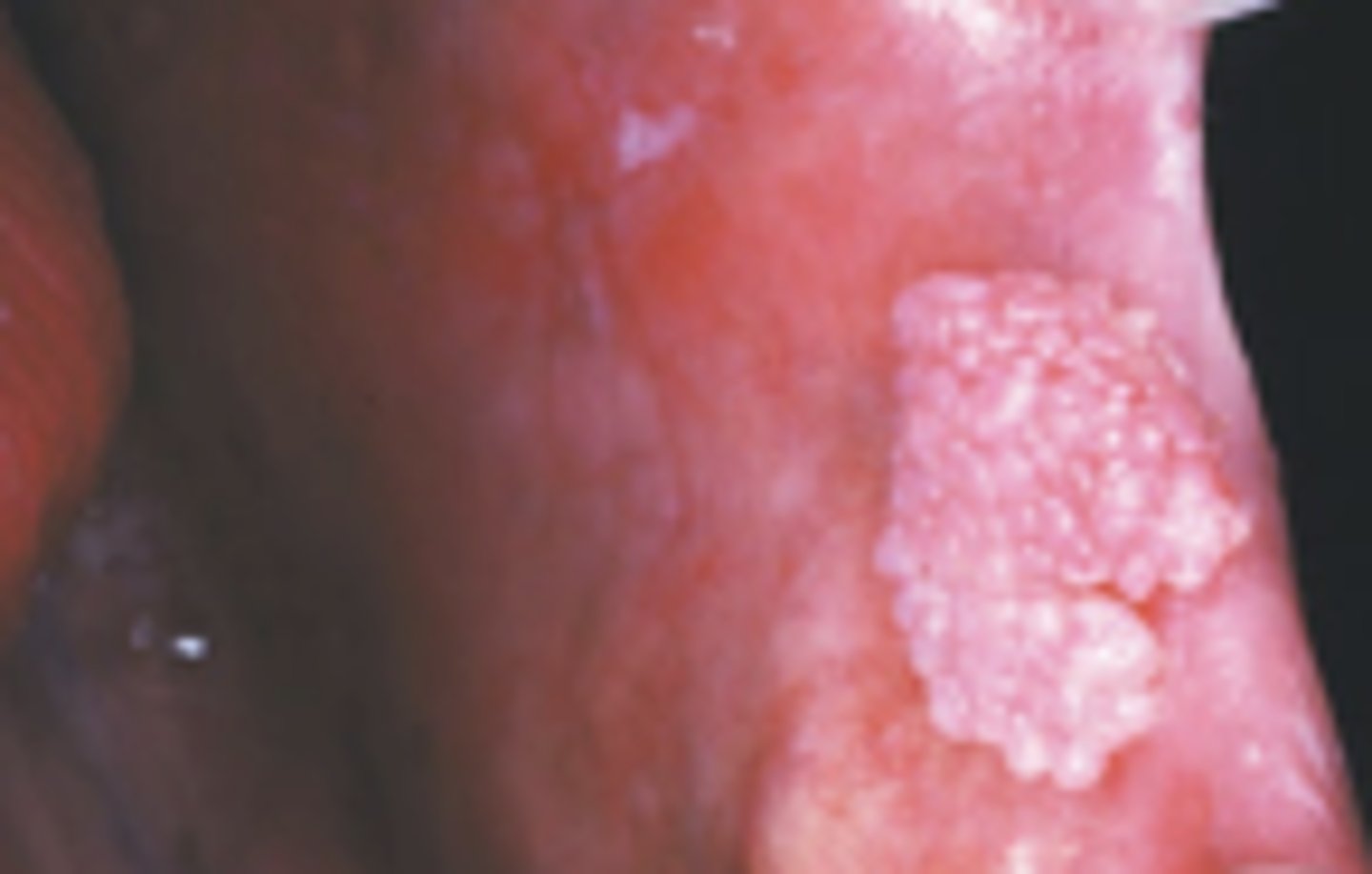 <p>Hint: numerous fingerlike surface projections OR "cauliflower" appearance</p>