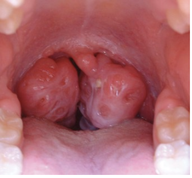 <p>How would you document the size of this patient’s tonsils?</p>
