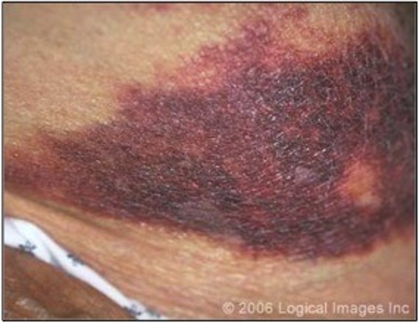 <p>larger blue or purplish patches on the skin (bruises)</p>