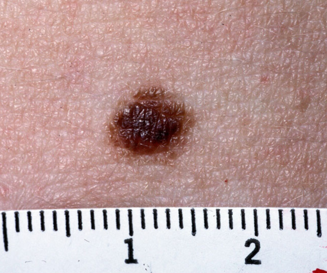 <p>Nevus</p>