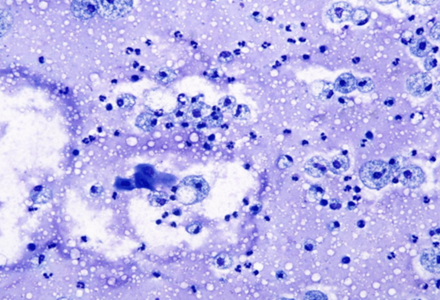 <p>what type of exudate is depicted microscopically?</p>