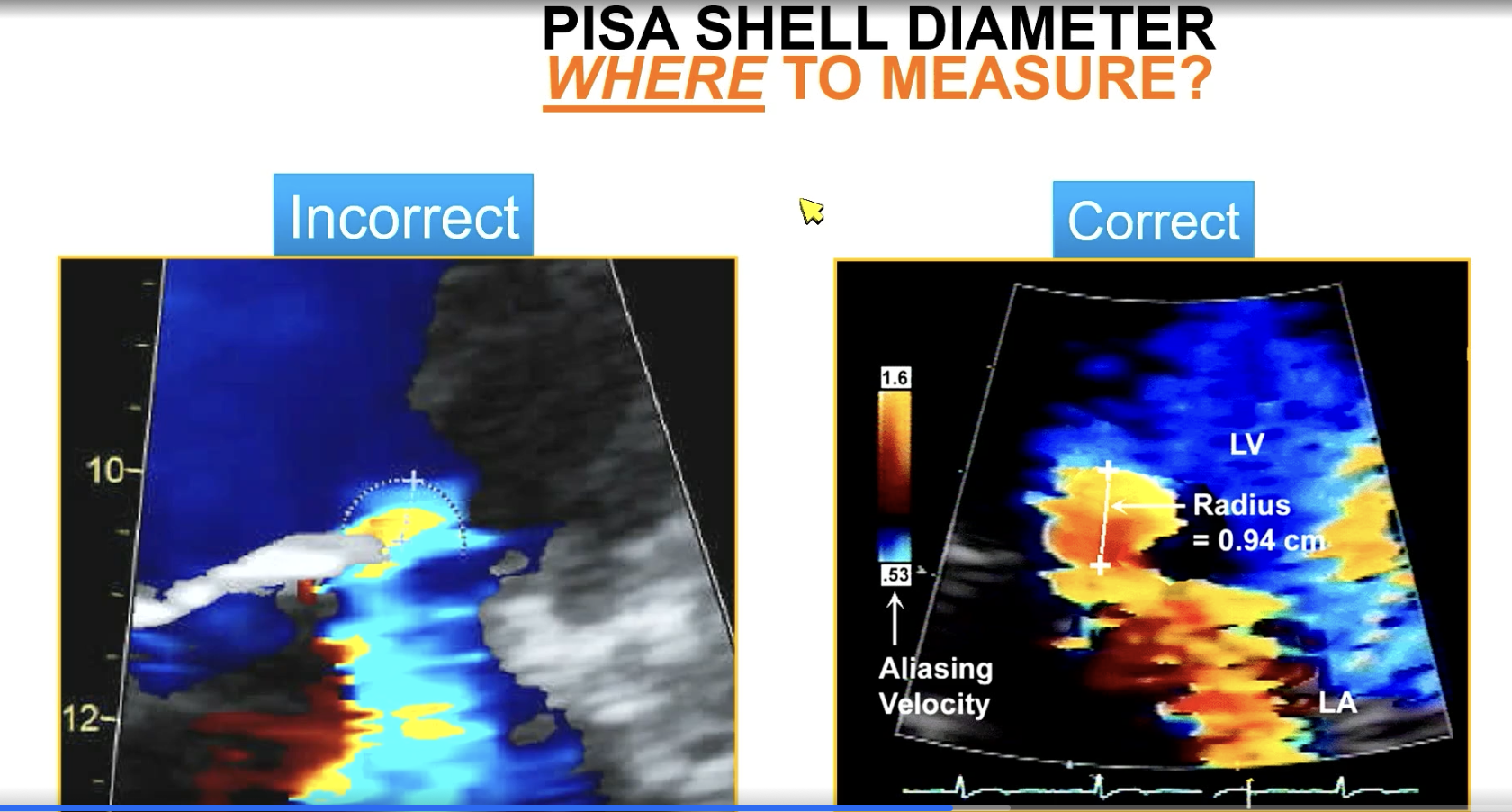 <p>Measure the PISA diameter from the color aliasing to…</p>