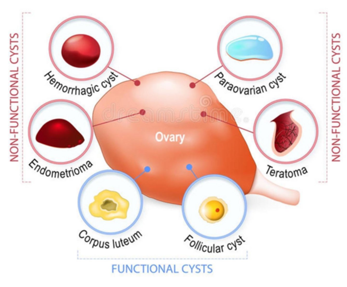 <p>Simple cysts (unilocular), thin walls, no solid components, and 'ground glass' echoes (endometriomas).</p>