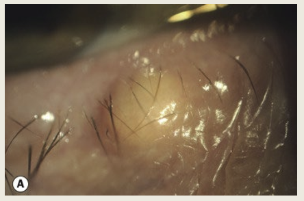 <p>A small translucent cyst on the anterior lid marign. It is caused by obstructed sebaceous gland associated with the eyelash follicle. The treatment is observation.</p>