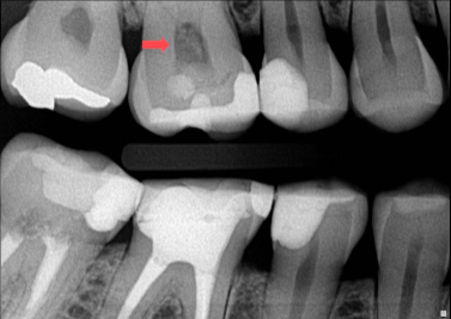 <p>ID the abnormality in the radiograph:</p>