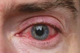 <p>Ocular rosacea and Chlamydial conjunctivitis.</p>
