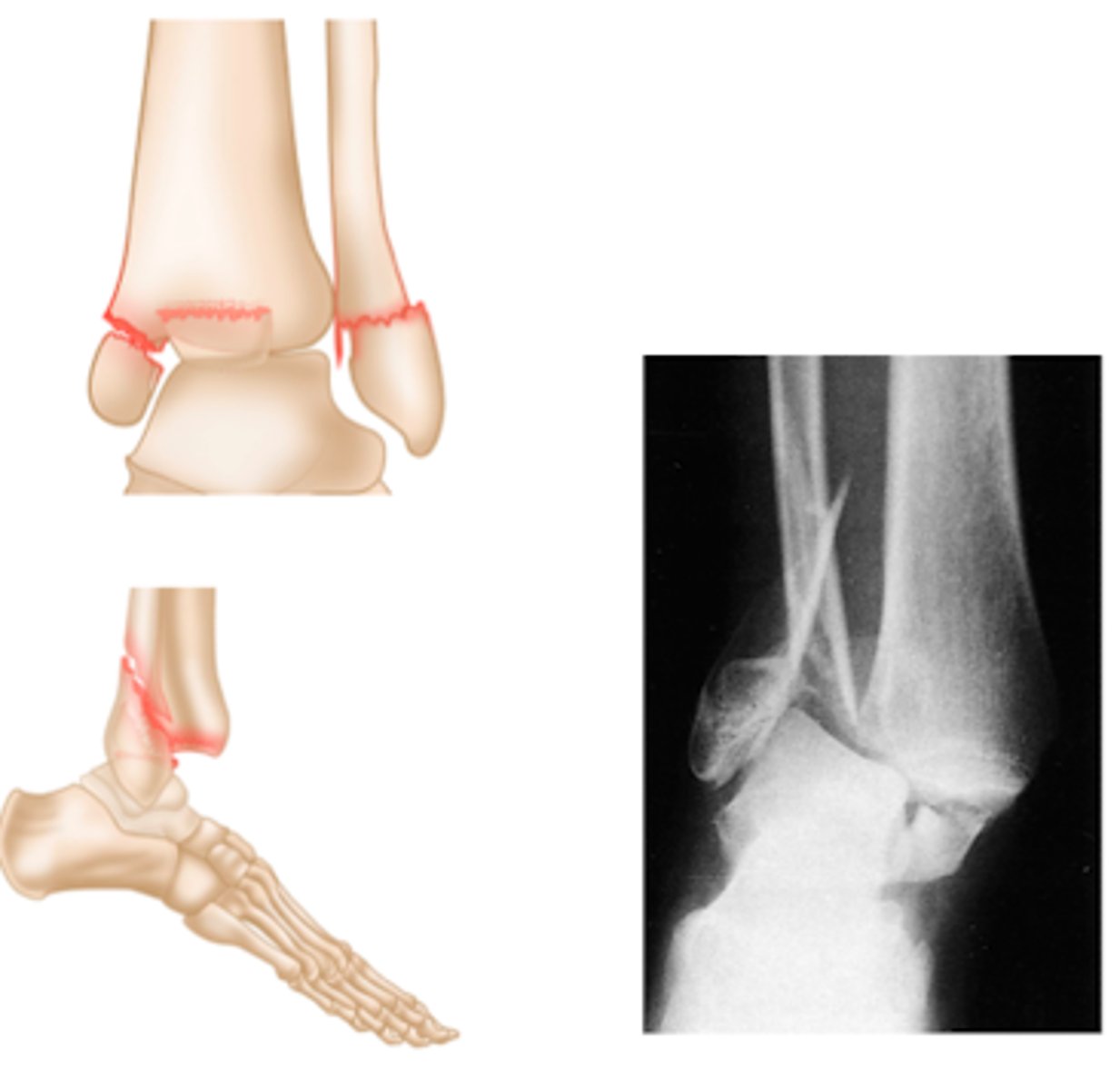 <p>involves all THREE malleoli - medial, lateral and </p>