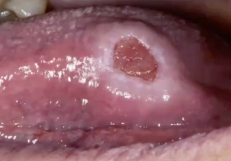 <p>persistant ulcer has been diagnosed. What would you like to RULE OUT?</p>