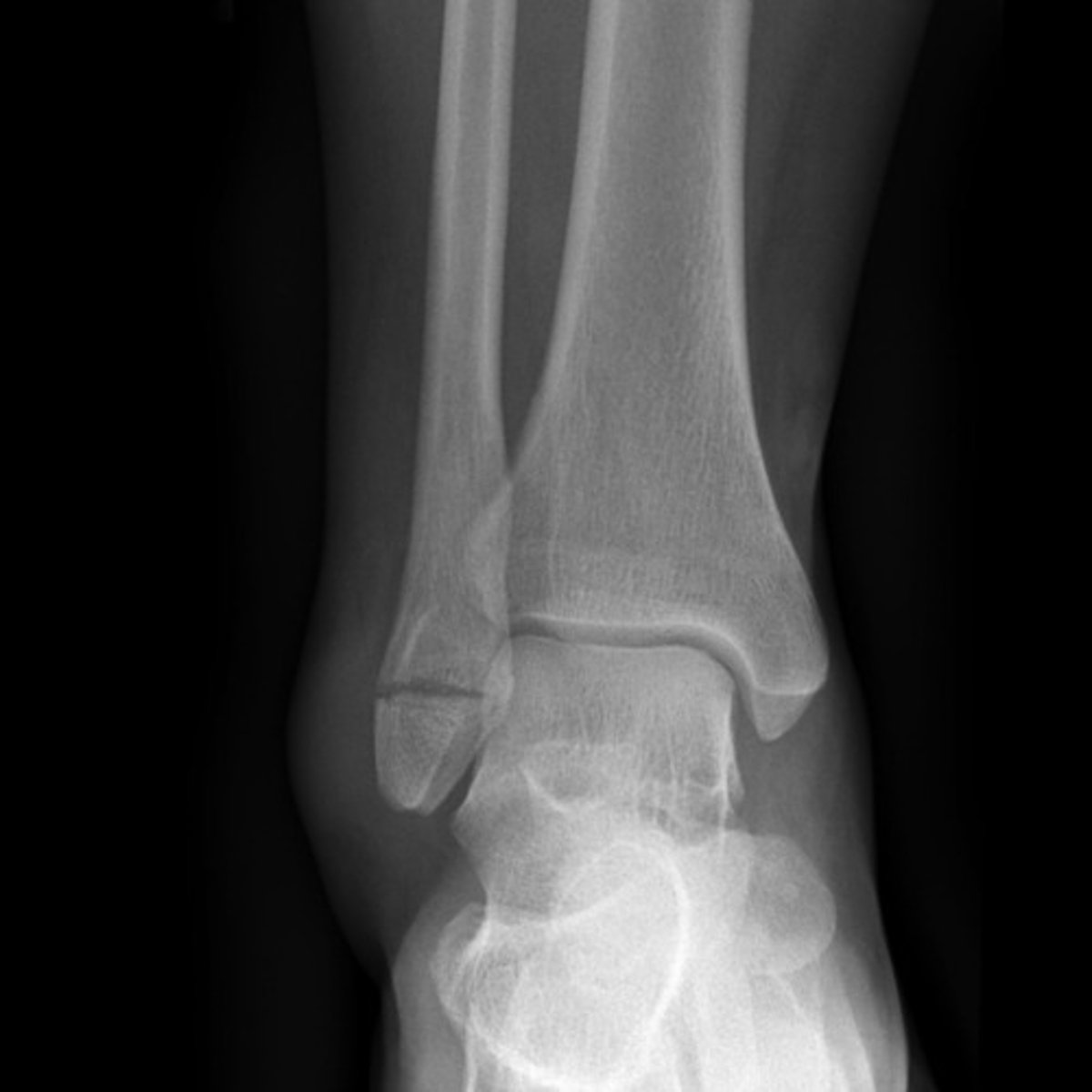 <p>fracture is below talar dome</p><p>- if fragment is minimally displaced, can treat w/ casting</p><p>- screw fixation is sometimes needed</p><p>generally NO surgery</p>
