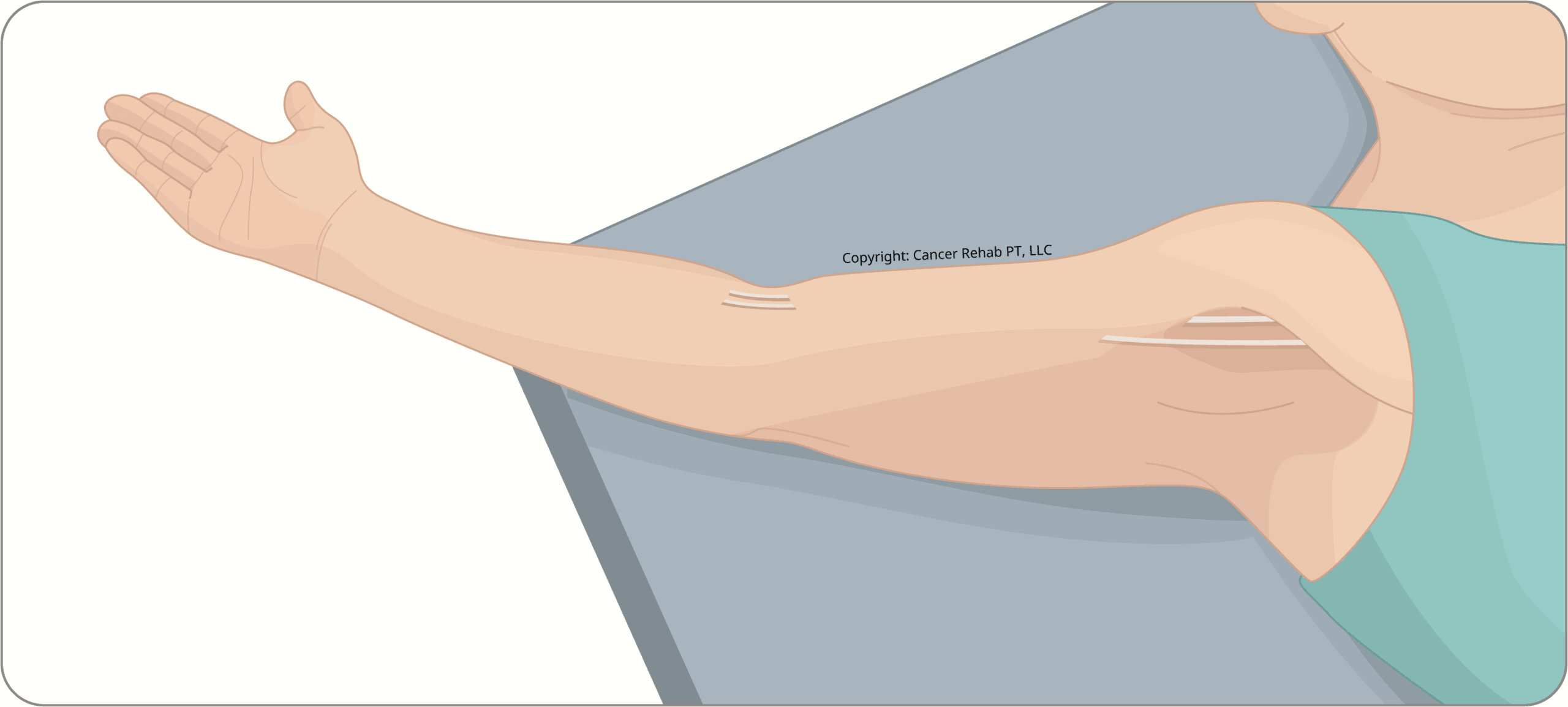 <p><span>commonly known as the armpit, is </span><strong><mark data-color="unset" style="background-color: unset; color: inherit;">an anatomical region located between the upper arm and the chest wall</mark></strong></p>