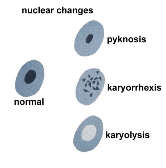 <p>Pyknosis (Irreversible injury)</p>