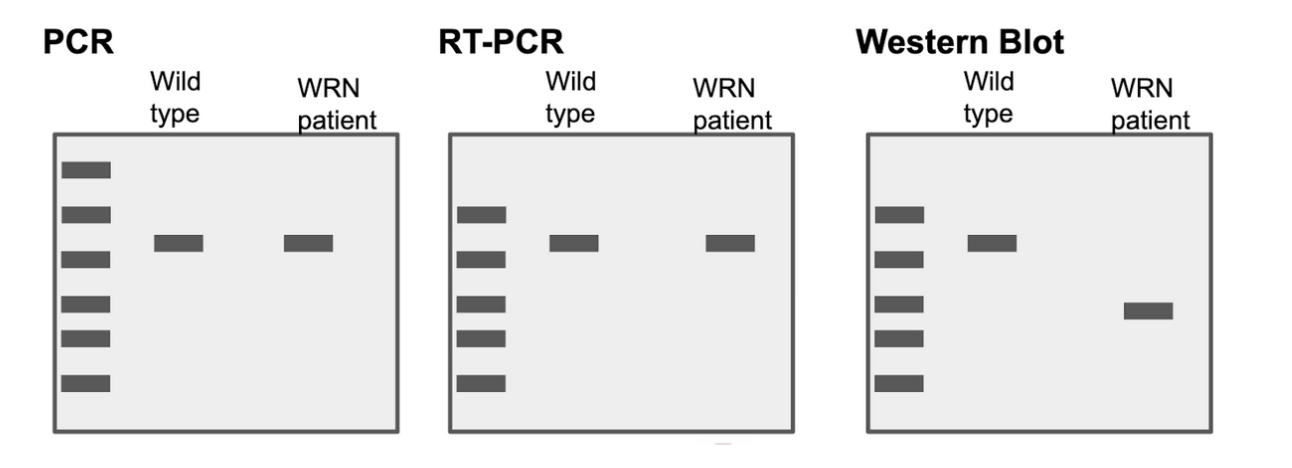 <p>The individual with Werner syndrome:</p><ol><li><p>Choice 1 of 3:Makes a protein that is longer than wildtype</p></li><li><p>Choice 2 of 3:Doesn’t make a protein</p></li><li><p>Choice 3 of 3:Makes a protein that is shorter than wildtype</p></li></ol>