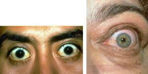 <p>PP:&nbsp;<span><span>abnormal elevation of the upper eyelid</span></span><br><span><span>or</span></span><br><span><span>depression of the lower eyelid</span></span></p><p>E: fine tremor+moist skin+heart rate 90+ bpm→hyperthyroidism<br>thyroid eye dx<br>aging<br>trauma<br>surgery</p><p>CM: wide-eyed stare<br>decreased rim of sclera between upper lid+iris<br>retracted upper/lower eyelids</p><p>PE:<br>lid lag→positive</p>