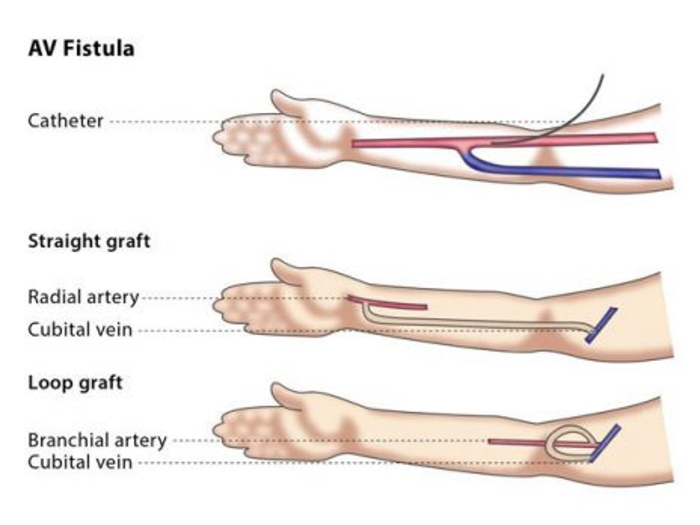 <p>interposition of prosthetic material between an artery and a vein; indicated if native AV fistula fails or anatomy does not support its placement; can be used in 2-3 weeks, but has increased risk of complications; mean long-term potency rates up to 2 years</p>