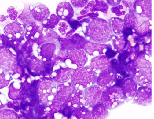 <p>Prominent vacuolation involving the cytoplasm of abnormal lymphoblast-like cells seen in the peritoneal body fluid preparation shown is a distinctive feature of which disease?</p><p></p><p>Hodgkin Lymphoma</p><p>Burkitt Lymphoma</p><p>Hairy Cell Leukemia</p><p>Chronic Lymphocytic Leukemia</p>