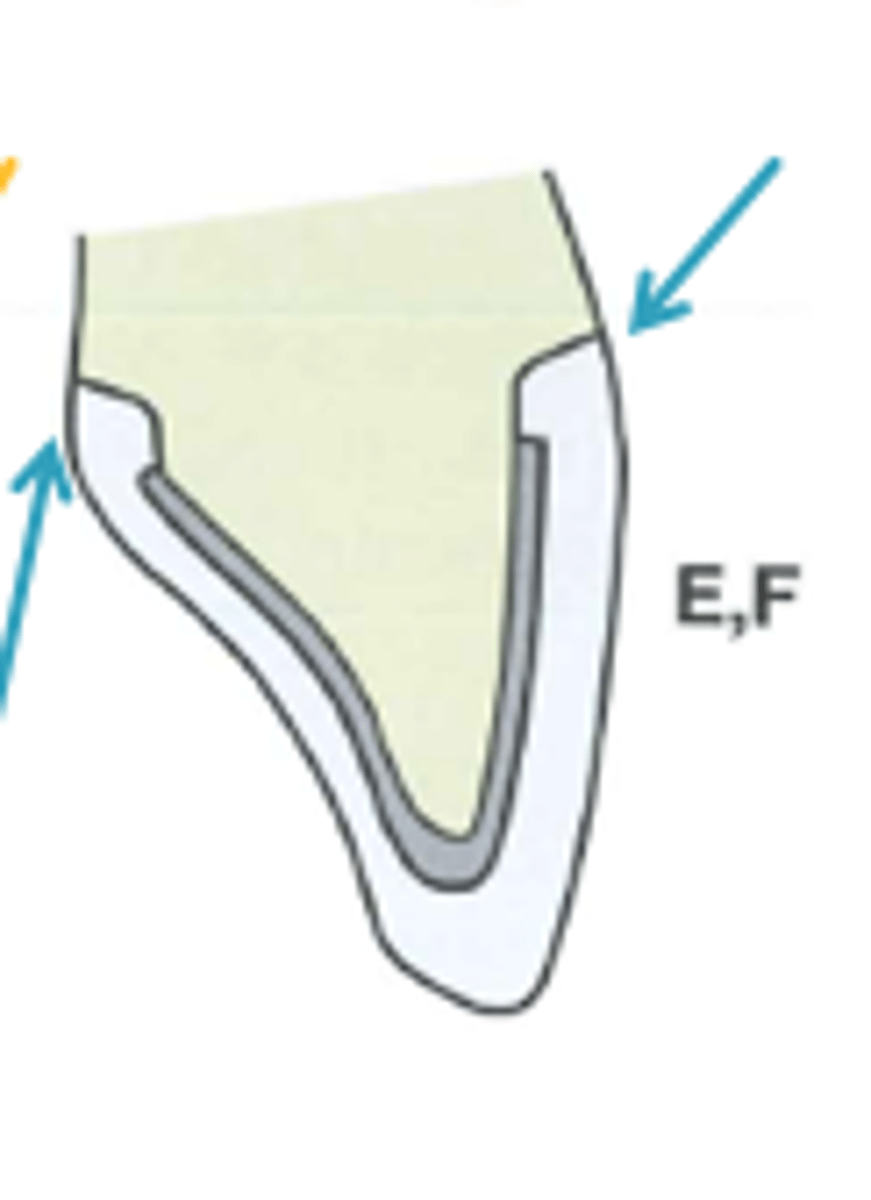 <p>what PFM margin is used when better esthetics are desired</p>