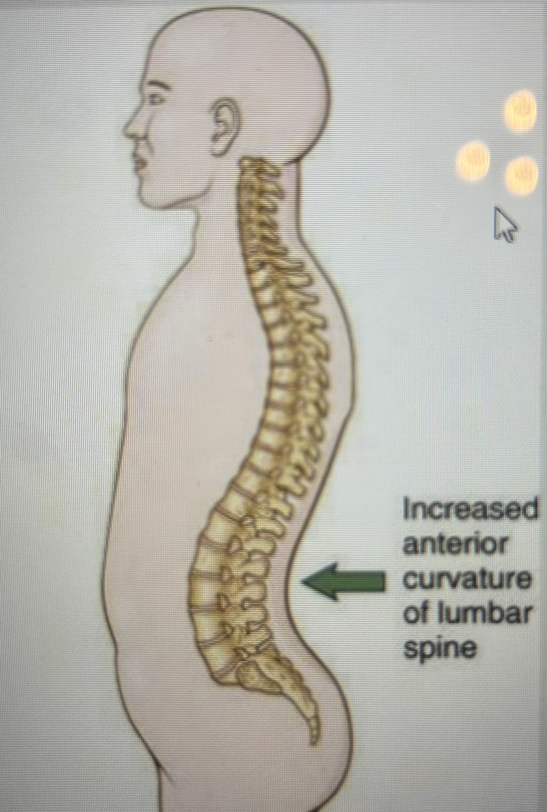 <p>What is this spinal curvature?</p>