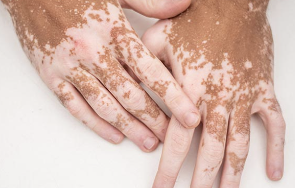 <p>Primary Skin Lesion</p><ul><li><p><strong>Flat</strong> discolored lesion of <strong>more than 1 cm</strong> with <strong>irregular border</strong></p></li><li><p>E.g., vitiligo</p></li></ul><p></p>