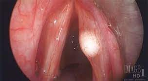 <ul><li><p>organic, structural</p></li><li><p>fluid-filled sac within the vocal folds</p></li><li><p>could be congenital or develop over time</p></li></ul>