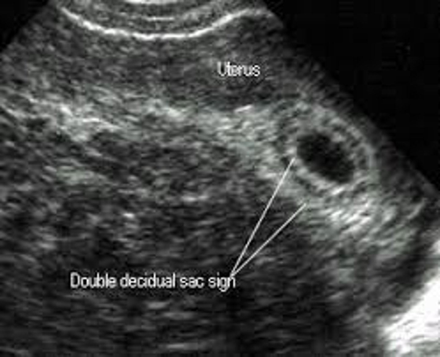 <p>decidua capsularis; endometrium</p>