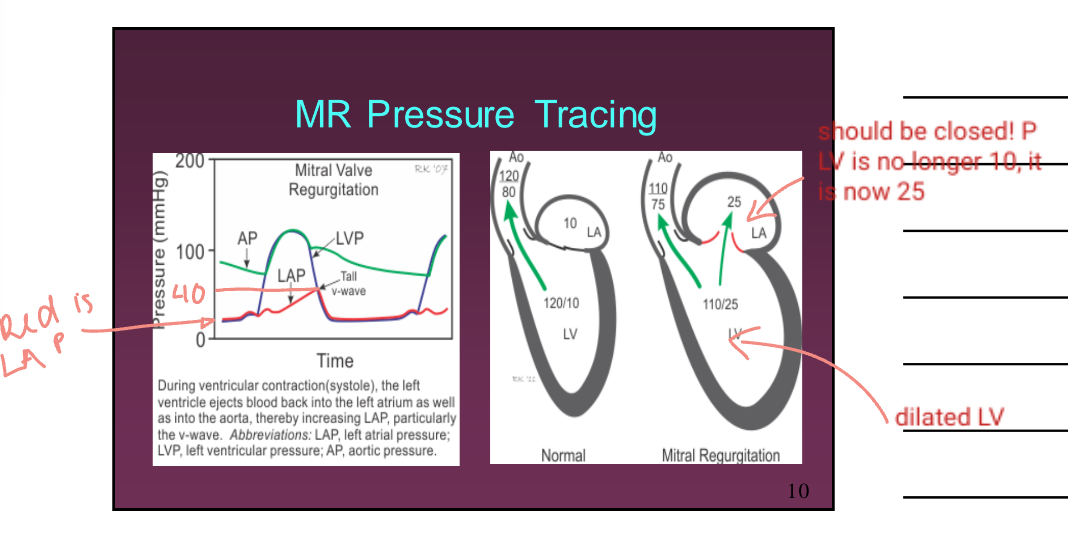 <p>The LA has time to compensate for the additional flow by dilating. Therefore this prevents LA pressure from increasing. The LA dilated is beneficial for this circumstance as the heart “fixes” itself for the meantime. However, over time this will become problematic.</p>