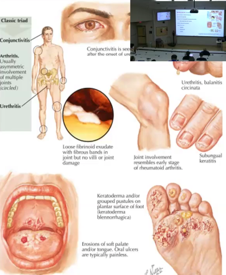 <ul><li><p>Inflammatory arthritis that <strong>lack the Rheumatoid Factor</strong></p></li><li><p>Classic Triad Presentation: Urethritis, arthritis and conjunctivitis</p></li></ul><p></p>
