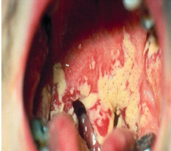 <p>identify  ? </p><p>type of bacteria ?  </p><p>complication ?</p><p>what is this membrane formed of ?</p>